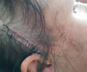 Pic of Surgery Scar